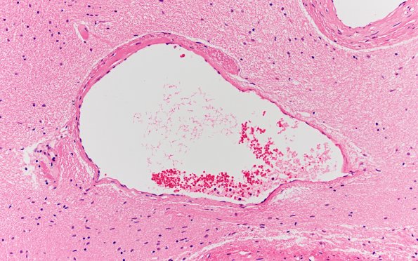 34B6 AVM, hybrid vessels (Case 34) H&E 20x