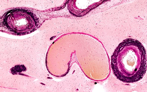 34C2 AVM, hybrid vessels (Case 34) VVG 10x 1