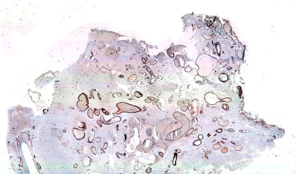 34D1 AVM, hybrid vessels (Case 34) SMA WM A