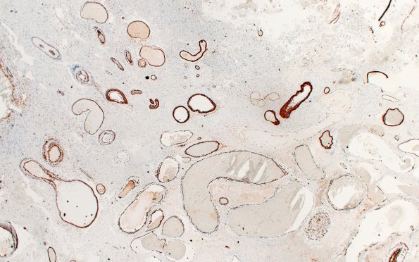 34D2 AVM, hybrid vessels (Case 34) SMA 2X