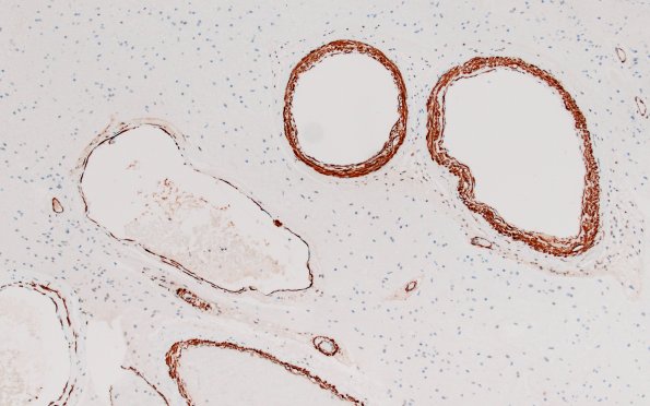 34D3 AVM, hybrid vessels (Case 34) SMA 10X