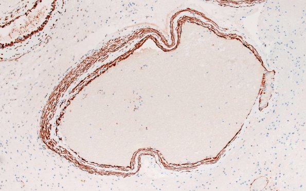 34D4 AVM, hybrid vessels (Case 34) SMA 10X 2