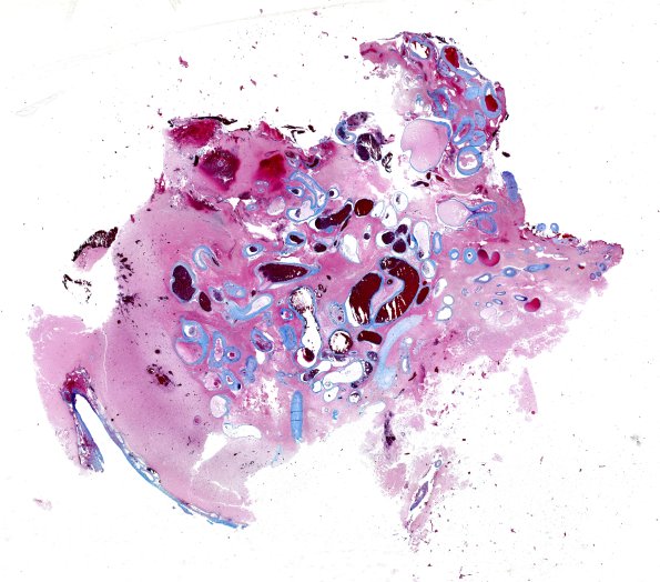 34E1 AVM, hybrid vessels (Case 34) Trichrome WM