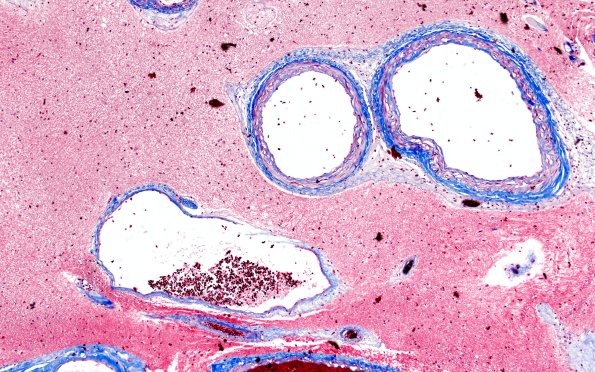 34E2 AVM, hybrid vessels (Case 34) TRI 10x 1