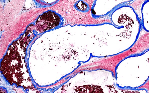 34E3 AVM, hybrid vessels (Case 34) TRI 10x 2