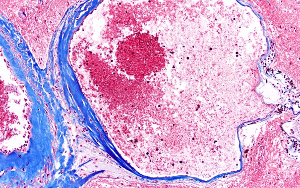 34E5 AVM, hybrid vessels (Case 34) TRI 20x 3