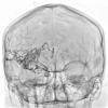 35A2 (Case 35) IR Angio int carotid R 1 - Copy