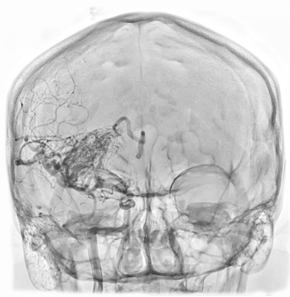 35A2 (Case 35) IR Angio int carotid R 1 - Copy