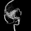 35A3 (Case 35) IR Angio int carotid R 2 - Copy