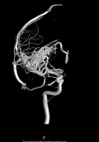35A3 (Case 35) IR Angio int carotid R 2 - Copy
