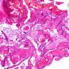 35B (Case 35) H&E 2X