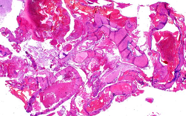 35B (Case 35) H&E 2X