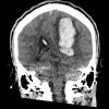 36A1 AVM (Case 36) CT 2 - Copy