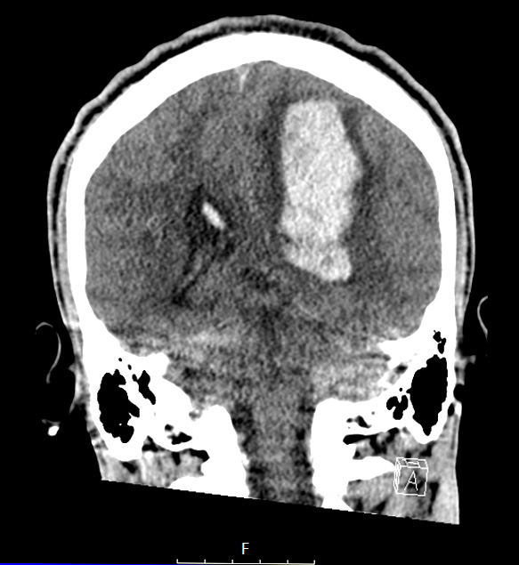 36A1 AVM (Case 36) CT 2 - Copy