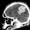 36A2 AVM (Case 36) CT 3 - Copy
