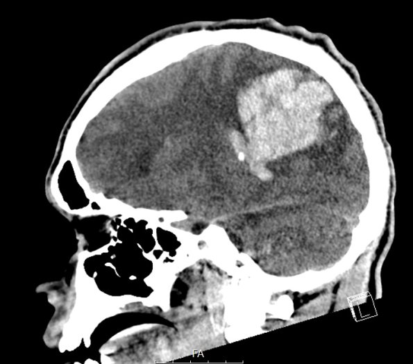 36A2 AVM (Case 36) CT 3 - Copy