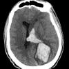 36A3 AVM (Case 36) CT - Copy