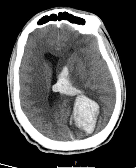 36A3 AVM (Case 36) CT - Copy
