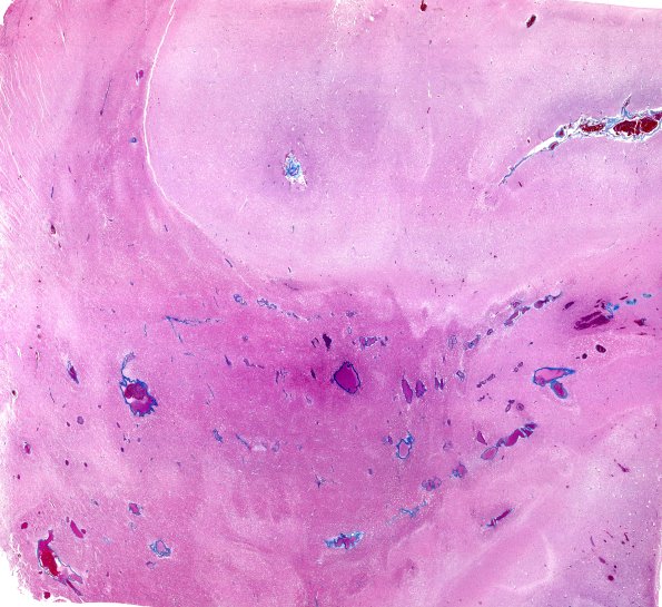 36D1 Case 36 A9 TRI WM