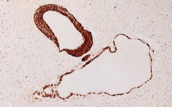 36F3A AVM (Case 36) A9 SMA 10X
