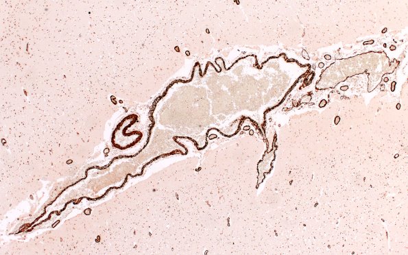 36F6 AVM (Case 36) A9 SMA 4X