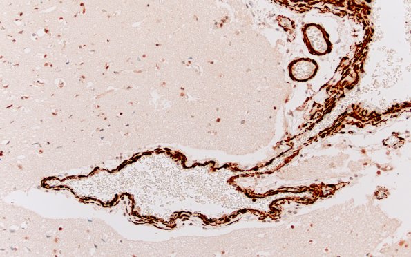 36F7 AVM (Case 36) A9 SMA 20X 1