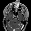 3A1 AVM (Case 3) T1 with contrast 1 copy - Copy