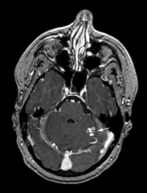 3A1 AVM (Case 3) T1 with contrast 1 copy - Copy