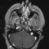 3A2 AVM (Case 3) T1 with contrast copy - Copy