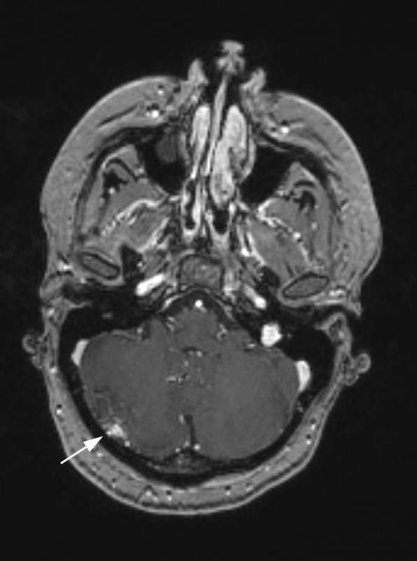 3A2 AVM (Case 3) T1 with contrast copy - Copy