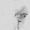 3A3 AVM (Case 3) angiogram - Copy