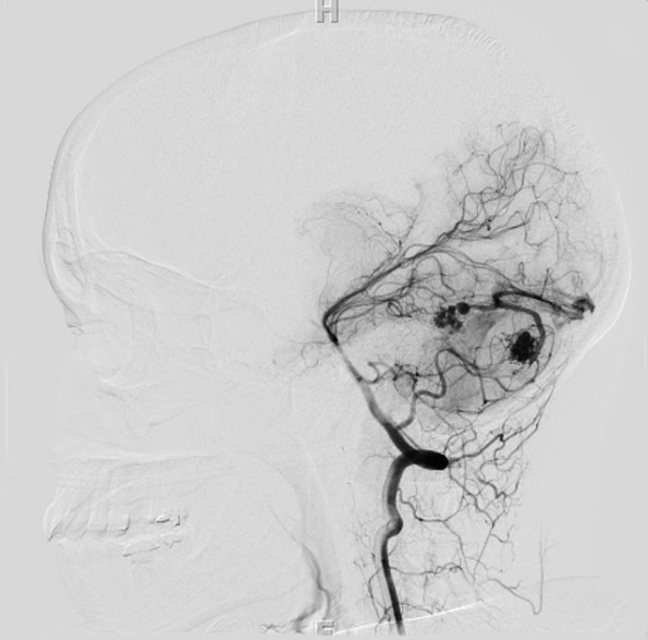 3A3 AVM (Case 3) angiogram - Copy