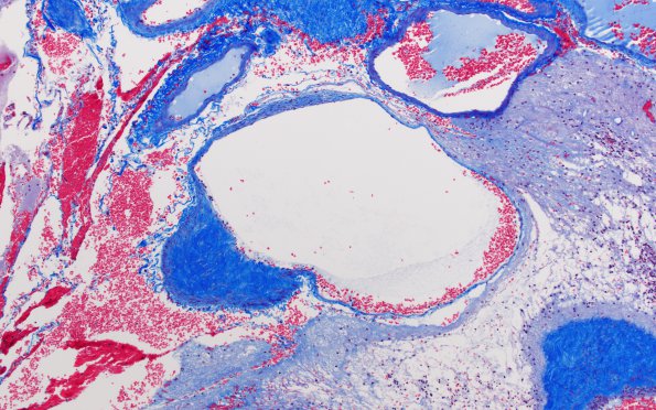 3B4 AVM (Case 3) A2 Trichrome 10X 1