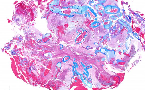 3C2 AVM (Case 3) A2 Trichrome 2X 1