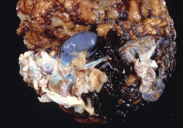 4A1 AVM (Case 4) neonate, H&E 3