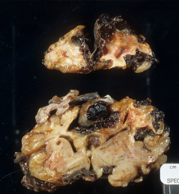 4A3 AVM, ho cardiac failure, (Case 4) 3