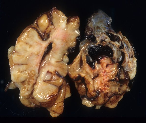 4A4 AVM, ho cardiac failure,  (Case 4) 12