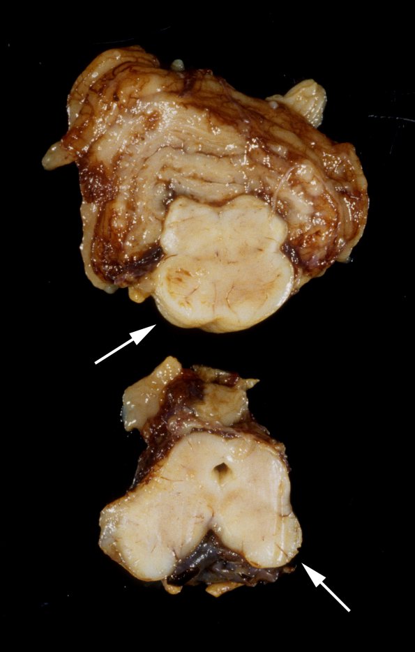 4A5 AVM, ho cardiac failure, (Case 4) 6 copy