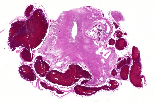 4B1 AVM (Case 4) neonate, N12 H&E WM