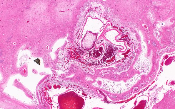 4B2 AVM (Case 4) neonate, H&E 7