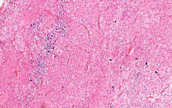 4B3 AVM (Case 4) neonate,  H&E 5