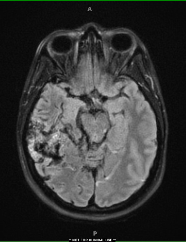 5A1 (Case 5) TIRM - Copy