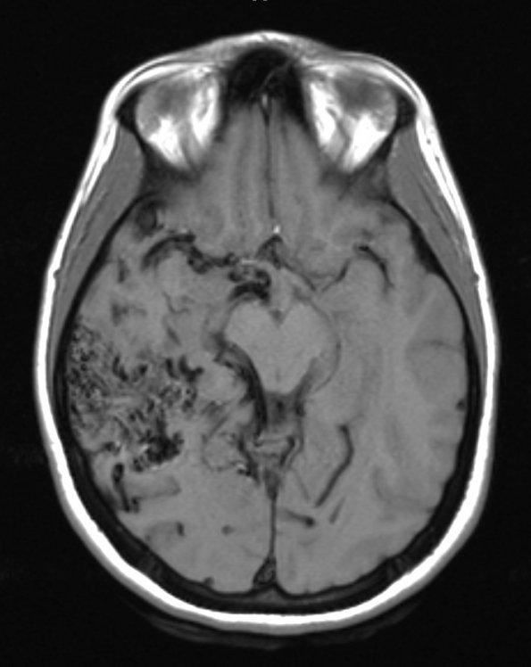 5A2 (Case 5) T1 no contrast - Copy