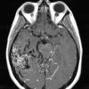 5A3 (Case 5) T1 with contrast - Copy