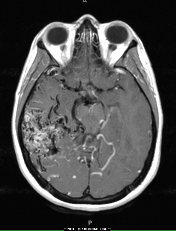 5A3 (Case 5) T1 with contrast - Copy