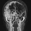 5A4 (Case 5) Angiogram (TWIST) - Copy