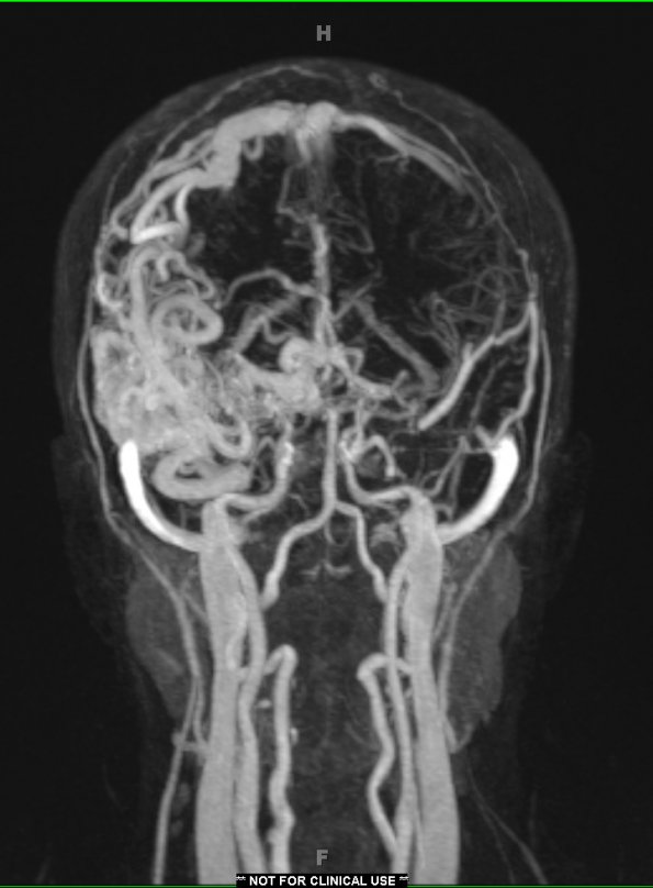 5A4 (Case 5) Angiogram (TWIST) - Copy