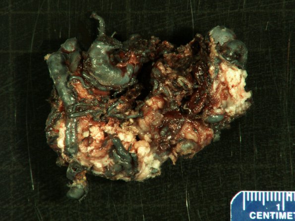 5B2 Arteriovenous Malformation & Onyx (Case 5) Gross _3