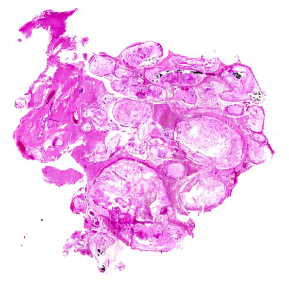 5C Arteriovenous Malformation & Onyx (Case 5) H&E WM