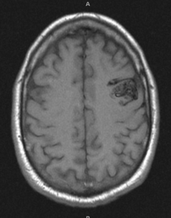 6A1 AVM (Case 6) T1 no contrast - Copy